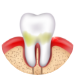 Gum Disease