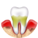 Periodontitis